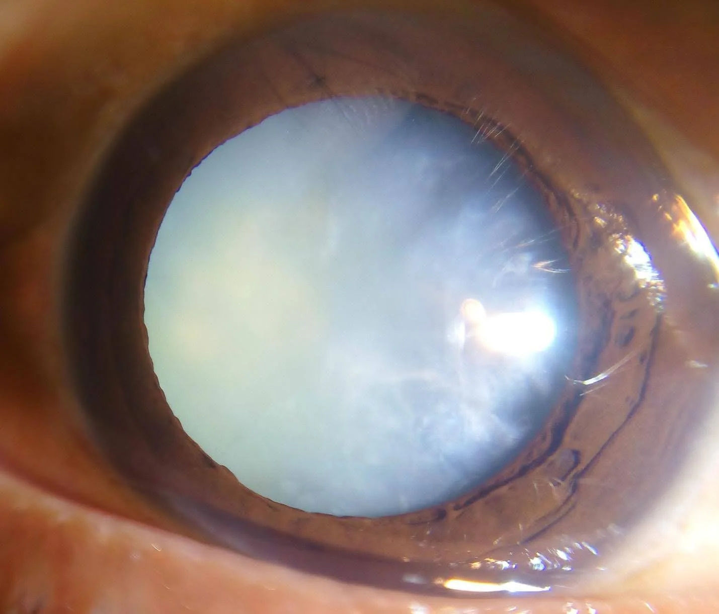 cataract 1