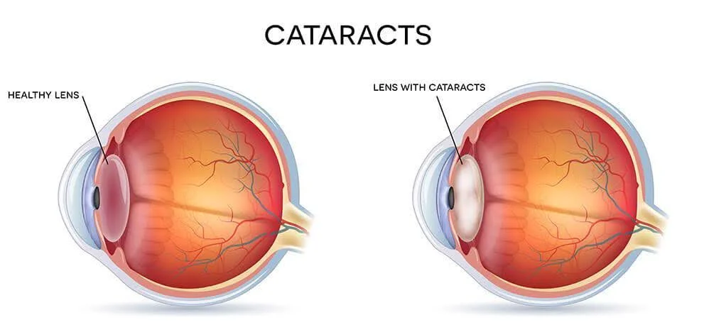 cataract 2